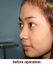 plastic_surgery_augmentation_rhinoplasty